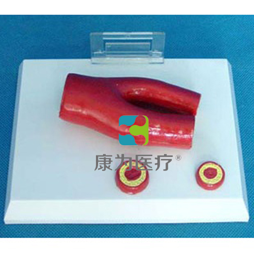 杭州“康为医疗”动脉病态血管模型
