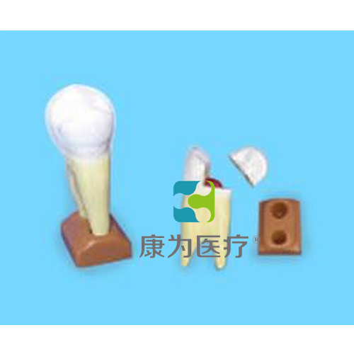 杭州“康为医疗”上颌两根龋齿模型(2部分，放大)