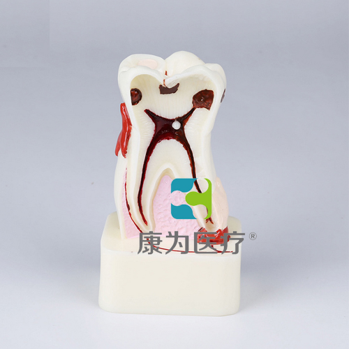 包头“康为医疗”四倍牙齿综合病模型